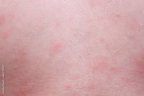Photo: Allergy skin Allergy skin