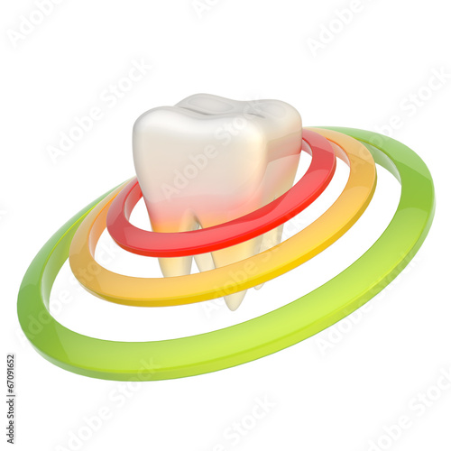 Illustration: Tooth encircled with rings Tooth encircled with rings