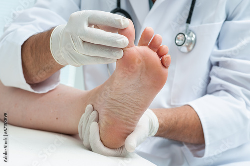 Photo: Tinia pedis or Athletes foot Tinia pedis or Athletes foot