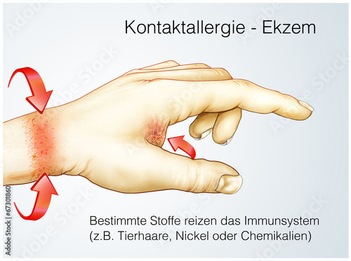 Illustration: Kontaktallergie.Haut-Ekzem Kontaktallergie.Haut-Ekzem