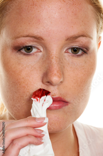 Photo: junge Frau hat Nasen bluten junge Frau hat Nasen bluten