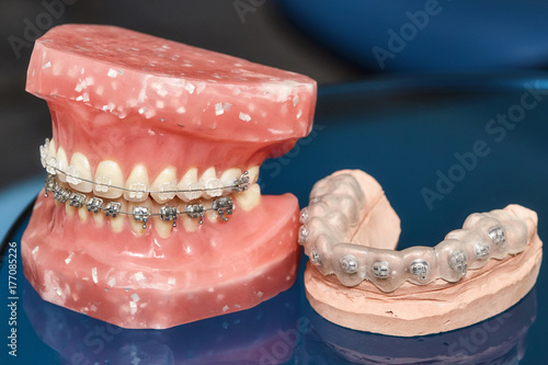 Human jaw or teeth model with metal wired dental braces