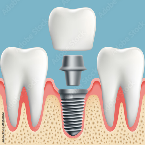 Human teeth and dental implant