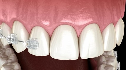Clear braces instalation on teeth. 3D animation