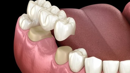 Dental bridge of 3 teeth over molar and premolar. Medically accurate 3D illustration of human teeth treatment