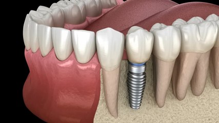 Premolar tooth recovery with implant. Medically accurate 3D animation of human teeth and dentures concept