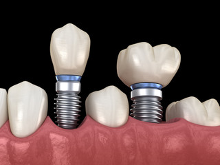 Premolar and Molar tooth crown installation over implant abutments. Medically accurate 3D illustration of human teeth and dentures concept