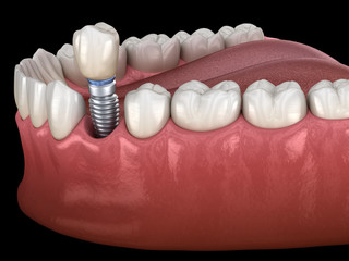 Premolar tooth crown installation over implant abutment. Medically accurate 3D illustration of human teeth and dentures concept