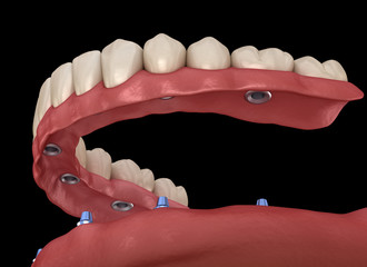 Mandibular prosthesis All on 6 system supported by implants. Medically accurate 3D illustration of human teeth and dentures concept