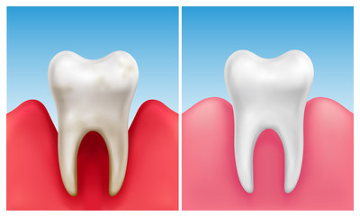 Vector illustration of gum disease -  periodontitis in compare with healthy white tooth