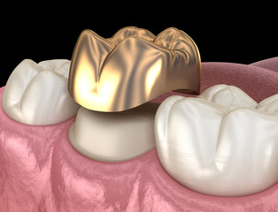 Golden crown molar tooth assembly process. Medically accurate 3D illustration of human teeth treatment