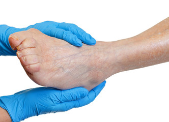 Come a gambe di bendaggio a varicosity