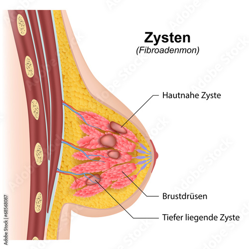 Die Implantate in die Brust die Operation