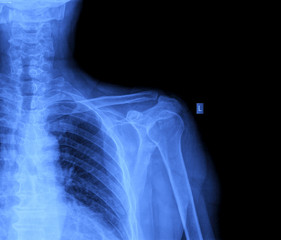 is bacterial bronchitis contagious
