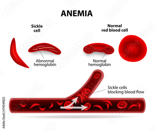 anemia Poster #F74544825 - PrintMePoster.com