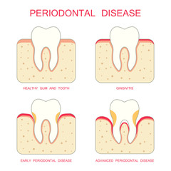 Vector: tooth periodontal disease, dental gum periodontists
