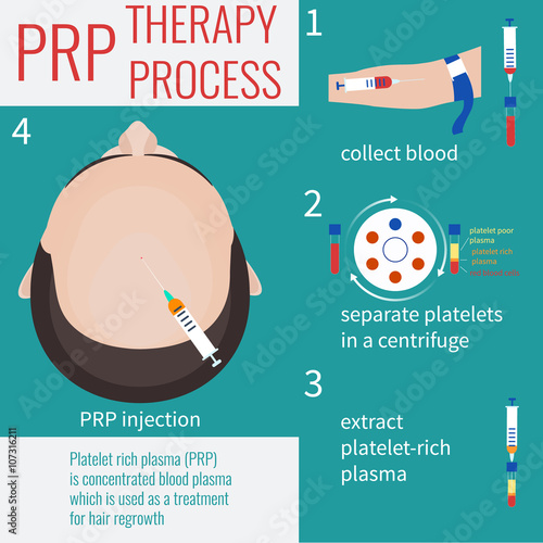 Platelet rich plasma injection. PRP therapy process. Male hair loss treatment infographics. PRP injection. PRP procedure.  Meso therapy. Hair growth stimulation. Male alopecia. Vector illustration.