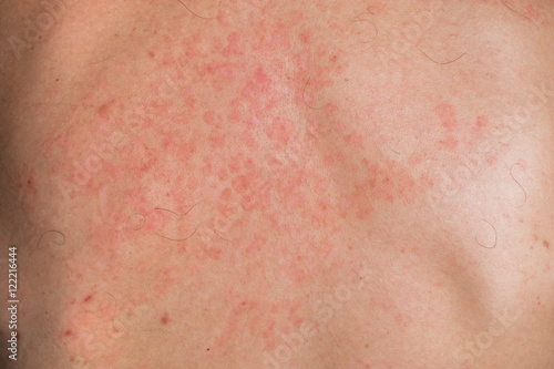 skin-fungus-white-spots-on-back