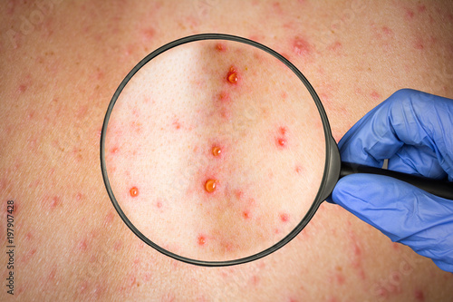Epidemic Rubella Viral Infection Concept Skin Bubble Rash Buy